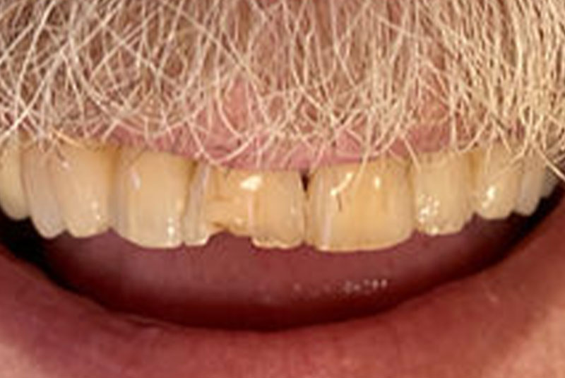 ba full mouth before