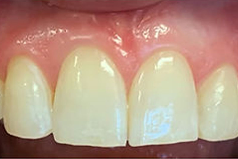 ba 8 veneer after