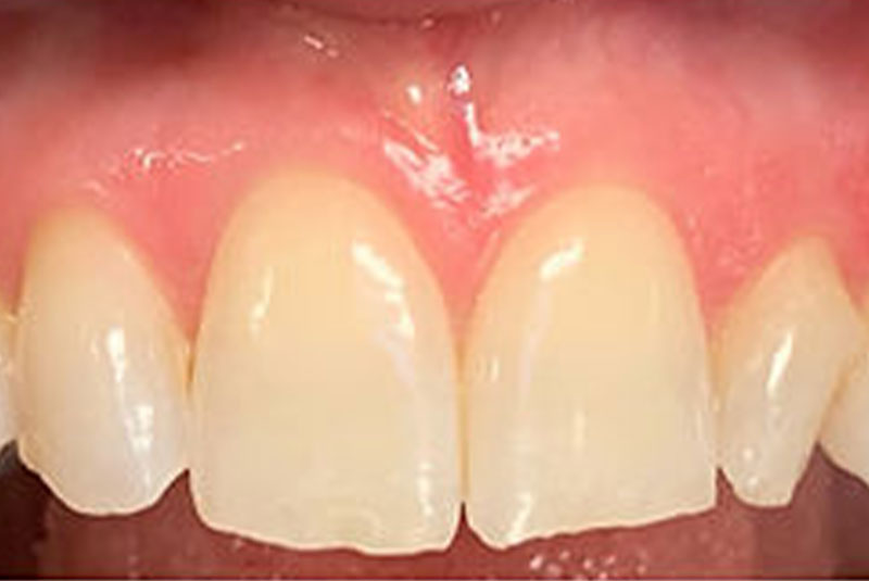 ba 8 veneer before