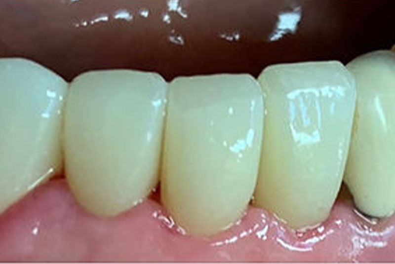ba bridge after