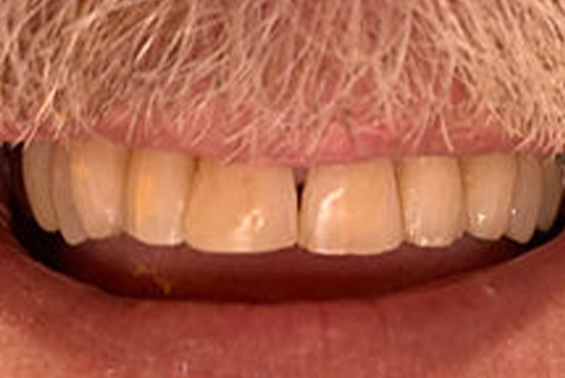 ba full mouth after