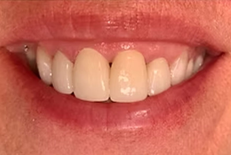 ba crown front after