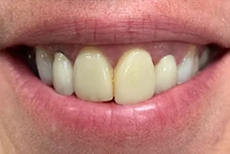 ba crown front before