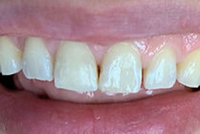ba after veneer