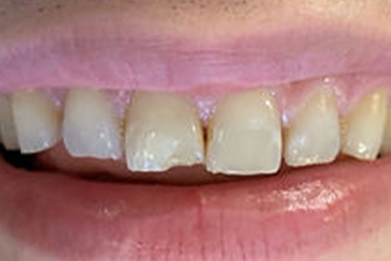 ba before veneer